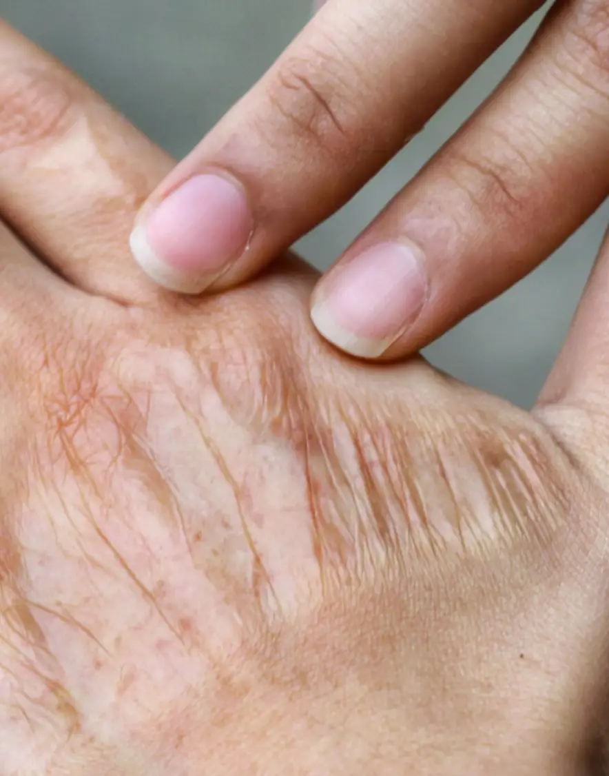 Attorney for Chemical Burns and Scarring Injuries